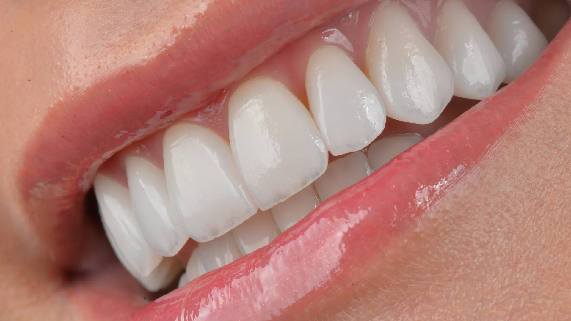 Qual a Diferença Entre Lentes de Contato Dental e Facetas de Porcelana?